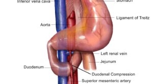 SMAS- Superior Mesenteric Artery Syndrome Symptoms, Treatment