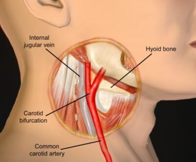 Carotid Sinus Massage, Hypersensitivity, Syndrome