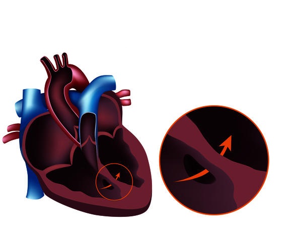 Holosystolic Murmur Symptoms, Causes, Sound, Treatment