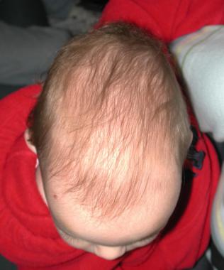 Dolichocephaly Definition, Pictures, Symptoms, Causes, Treatment