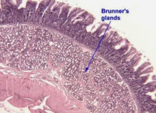 Brunner's gland Hyperplasia Symptoms, Causes, Cancer, Treatment