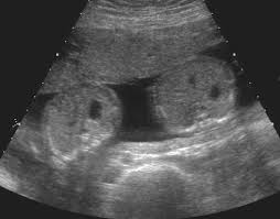 Fetus Papyraceus Definition, Symptoms, Causes, Treatment