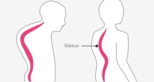Gibbus Deformity Definition, Symptoms, Causes, Treatment
