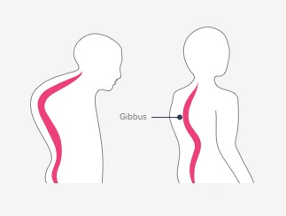 Gibbus Deformity Definition, Symptoms, Causes, Treatment