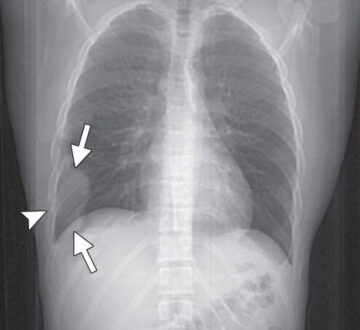 Askin Tumor vs. Ewing Sarcoma Difference, Symptoms, Causes, and treatment