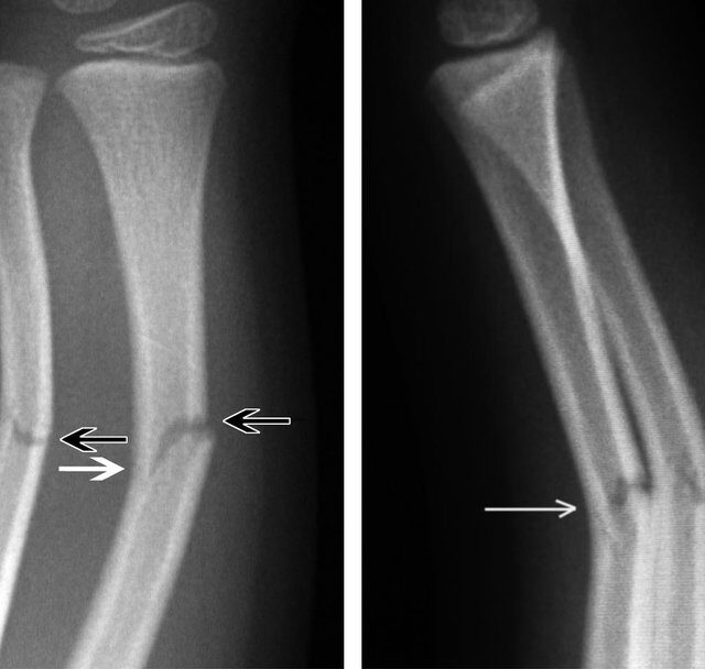 Greenstick vs Nightstick Fracture Difference, Symptoms, Causes, Treatment