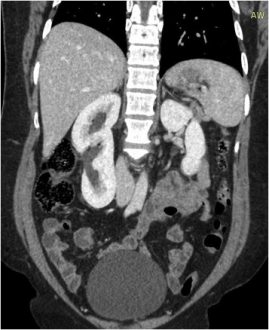 Supernumerary kidney Symptoms, Causes, Complications, Treatment