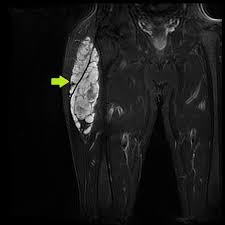 Myxoid chondrosarcoma Stages, Prognosis, Treatment, Life expectancy