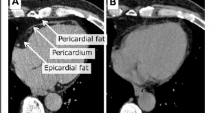 Epicardial Fat vs Pericardial Fat Symptoms, Causes, Treatment