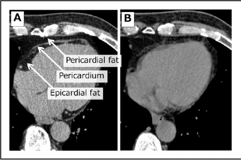 Epicardial Fat vs Pericardial Fat Symptoms, Causes, Treatment