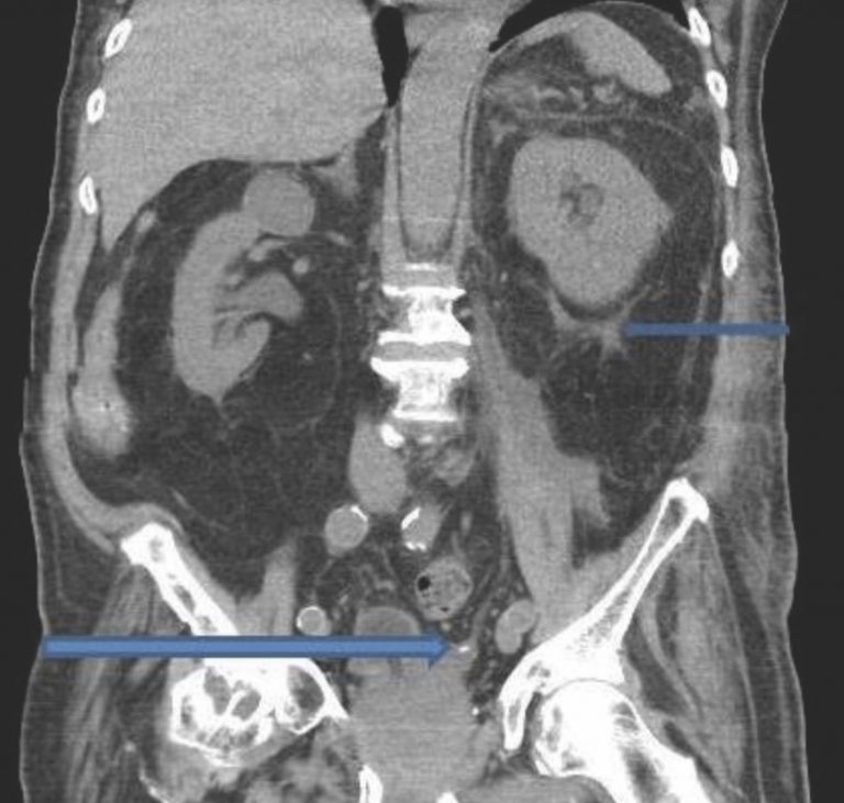 Calyceal Stone Symptoms Causes Size Treatment