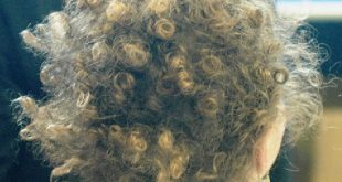 Woolly Hair Syndrome Symptoms, Causes, Diagnosis, Treatment