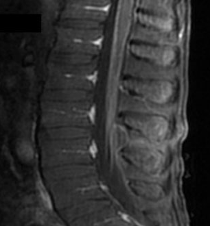 Elsberg Syndrome Symptoms, Causes, Diagnosis, Treatment