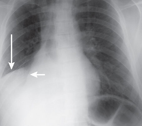 Middle Lobe Syndrome Symptoms, Causes, Diagnosis, Treatment