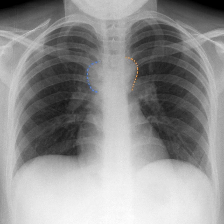 Precarinal Lymph Node Location, Size, Enlargement, Cancer