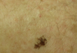 Ink Spot Lentigo Symptoms, Causes, Dermoscopy, Removal