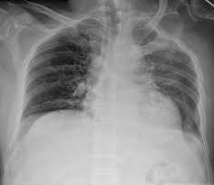 Needle Thoracostomy Location, Indications, Procedure | Needle Thoracostomy vs Chest tube