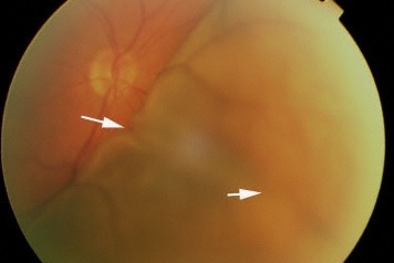 Choroidal Folds Symptoms, Causes, Diagnosis, Treatment