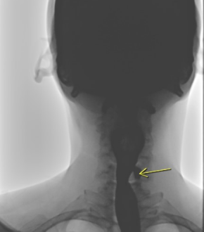 Killian Jamieson Diverticulum Symptoms, Location, Causes, Diagnosis, Treatment