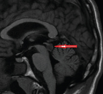 Tectal Glioma Symptoms, Causes, Prognosis, Treatment