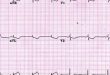 Anteroseptal infarct Symptoms, Cause, ECG/EKG, Treatment