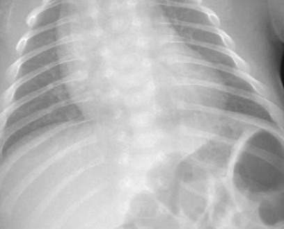 Cleidocranial Dysostosis Meaning, Symptoms, Causes, Diagnosis, Treatment
