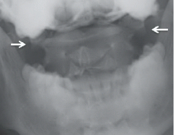 What is Jefferson fracture - Type 1, Type 2, & Type 3