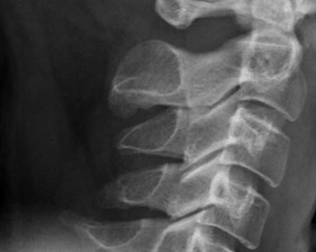 What is cervical calcification? - Symptoms, Causes, Treatment