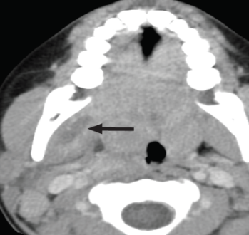 Masticator Space Definition, Abscess, Mass, Infection, Boundaries