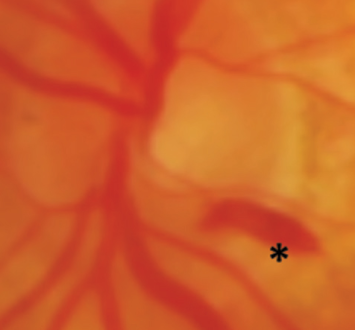 Subhyloid Hemorrhage Meaning, Symptoms, Causes, Treatment  Preretinal hemorrhage vs Vitreous hemorrhage