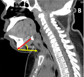 Thyromental distance Evaluation, Measurement, Fingerbreadths, Anesthesia