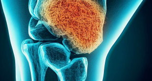 Mucoid Degeneration ACL Symptoms, Causes, Treatment