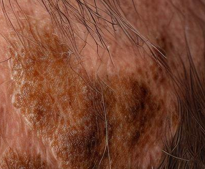 Erosive Pustular Dermatosis of the Scalp Symptoms, Causes, Treatment