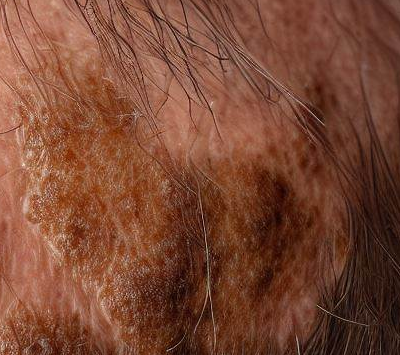 Erosive Pustular Dermatosis of the Scalp Symptoms, Causes, Treatment