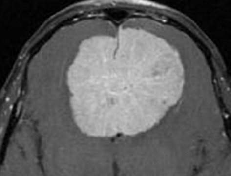 icd 10 parasagittal meningioma